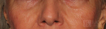 Ultherapy® Treatment Before - Paramus, NJ