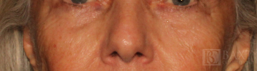 Ultherapy® Treatment After - Paramus, NJ