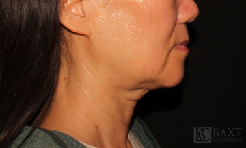 Ultherapy® Treatment Before - Paramus, NJ