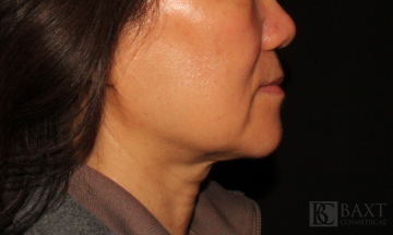 Ultherapy® Treatment After - Paramus, NJ