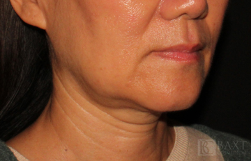 Ultherapy® Treatment Before - Paramus, NJ