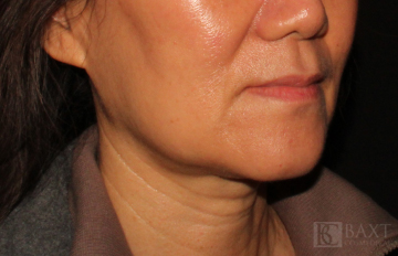 Ultherapy® Treatment After - Paramus, NJ