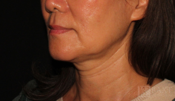 Ultherapy® Treatment Before - Paramus, NJ