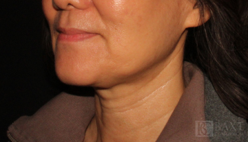 Ultherapy® Treatment After - Paramus, NJ