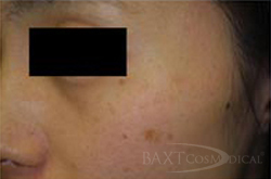 Vbeam Perfecta Treatment Before - Paramus, NJ Vbeam Perfecta Treatment Before - Paramus, NJ