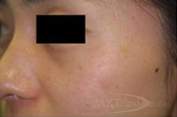 Vbeam Perfecta Treatment After - Paramus, NJ Vbeam Perfecta Treatment After - Paramus, NJ