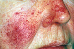 Closeup of patient Before Rosacea Treatment
