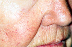 Closeup of patient after Rosacea Treatment