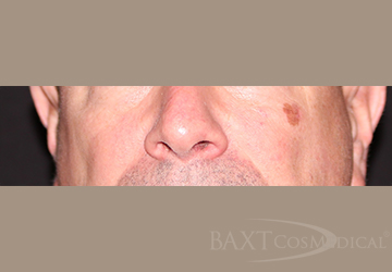 Vbeam Perfecta Treatment Before - Paramus, NJ Vbeam Perfecta Treatment Before - Paramus, NJ