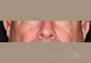 Vbeam Perfecta Treatment After - Paramus, NJ Vbeam Perfecta Treatment After - Paramus, NJ