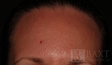 Vbeam Perfecta Treatment Before - Paramus, NJ Vbeam Perfecta Treatment Before - Paramus, NJ