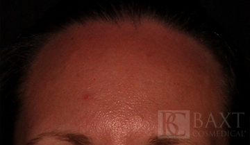 Vbeam Perfecta Treatment After - Paramus, NJ Vbeam Perfecta Treatment After - Paramus, NJ