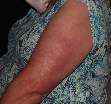 Vbeam Perfecta Treatment Before - Paramus, NJ Vbeam Perfecta Treatment Before - Paramus, NJ