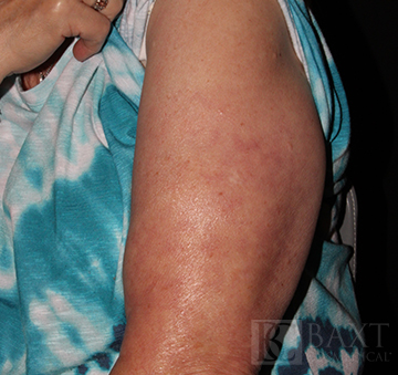 Vbeam Perfecta Treatment After - Paramus, NJ Vbeam Perfecta Treatment After - Paramus, NJ