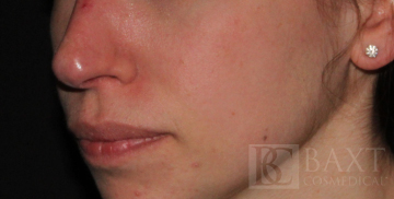 Vbeam Perfecta Treatment Before - Paramus, NJ Vbeam Perfecta Treatment Before - Paramus, NJ