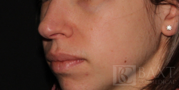 Vbeam Perfecta Treatment After - Paramus, NJ Vbeam Perfecta Treatment After - Paramus, NJ