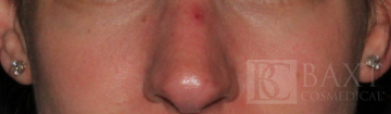 Vbeam Perfecta Treatment Before - Paramus, NJ Vbeam Perfecta Treatment Before - Paramus, NJ