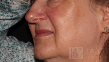 Vbeam Perfecta Treatment Before - Paramus, NJ Vbeam Perfecta Treatment Before - Paramus, NJ