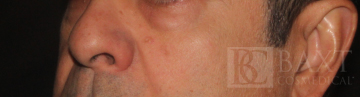 Vbeam Perfecta Treatment After - Paramus, NJ Vbeam Perfecta Treatment After - Paramus, NJ