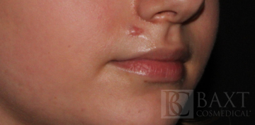 Vbeam Perfecta Treatment Before - Paramus, NJ Vbeam Perfecta Treatment Before - Paramus, NJ