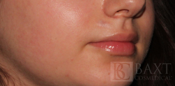 Vbeam Perfecta Treatment After - Paramus, NJ Vbeam Perfecta Treatment After - Paramus, NJ