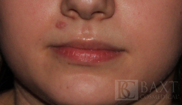 Vbeam Perfecta Treatment Before - Paramus, NJ Vbeam Perfecta Treatment Before - Paramus, NJ