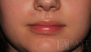 Vbeam Perfecta Treatment After - Paramus, NJ Vbeam Perfecta Treatment After - Paramus, NJ