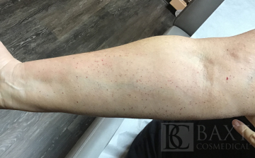 Vbeam Perfecta Treatment Before - Paramus, NJ Vbeam Perfecta Treatment Before - Paramus, NJ