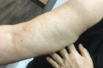 Vbeam Perfecta Treatment Before - Paramus, NJ Vbeam Perfecta Treatment Before - Paramus, NJ