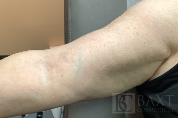 Vbeam Perfecta Treatment After - Paramus, NJ Vbeam Perfecta Treatment After - Paramus, NJ