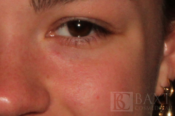 Vbeam Perfecta Treatment After - Paramus, NJ Vbeam Perfecta Treatment After - Paramus, NJ