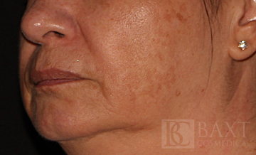 Vbeam Perfecta Treatment Before - Paramus, NJ