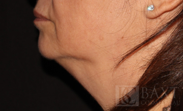 Vbeam Perfecta Treatment After - Paramus, NJ
