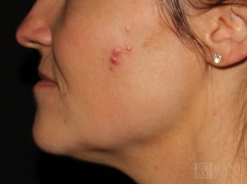 Vbeam Perfecta Treatment Before - Paramus, NJ