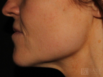Vbeam Perfecta Treatment After - Paramus, NJ