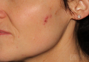 Vbeam Perfecta Treatment Before - Paramus, NJ
