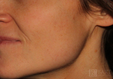 Vbeam Perfecta Treatment After - Paramus, NJ